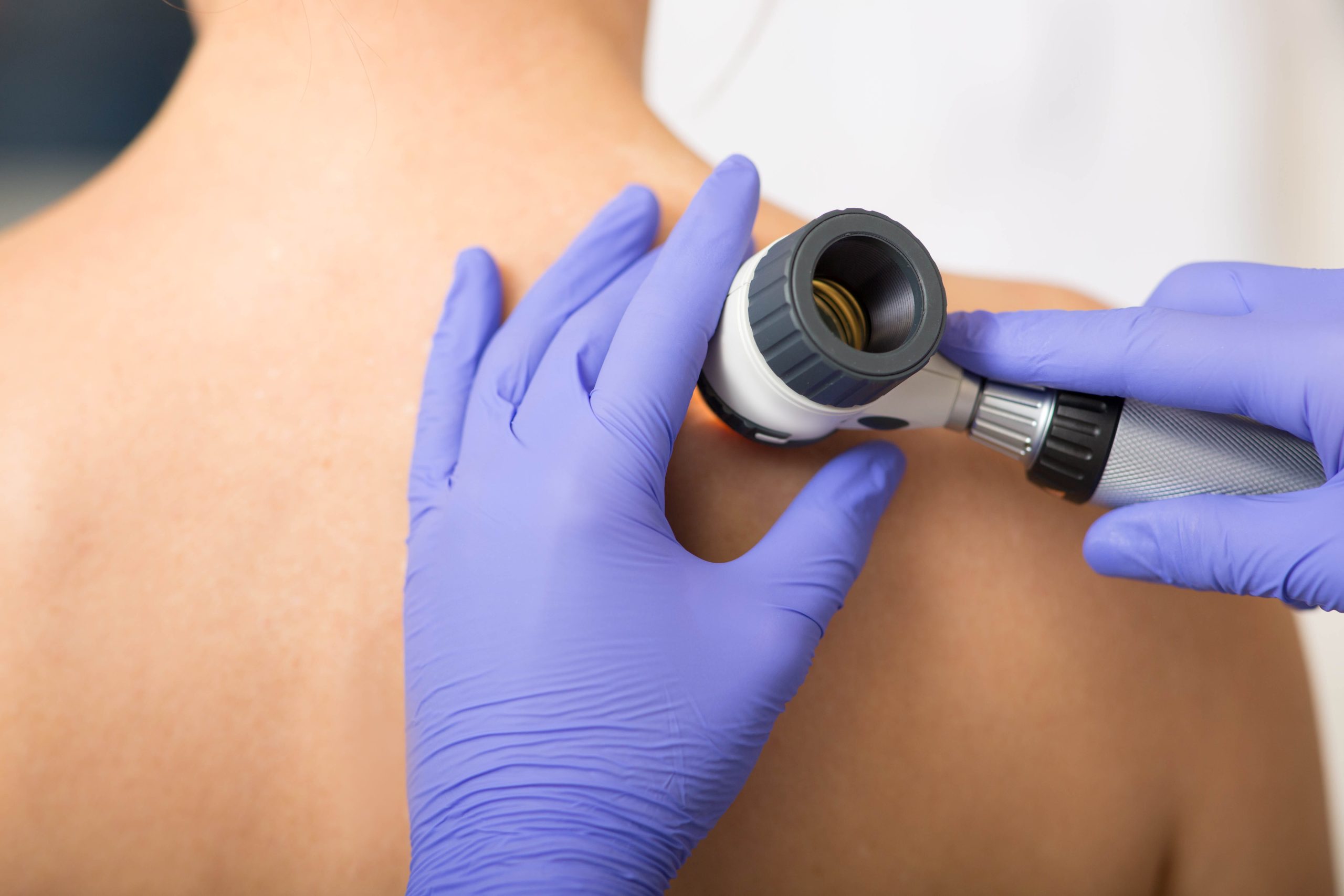Skin cancer diagnostics in Turlock, CA