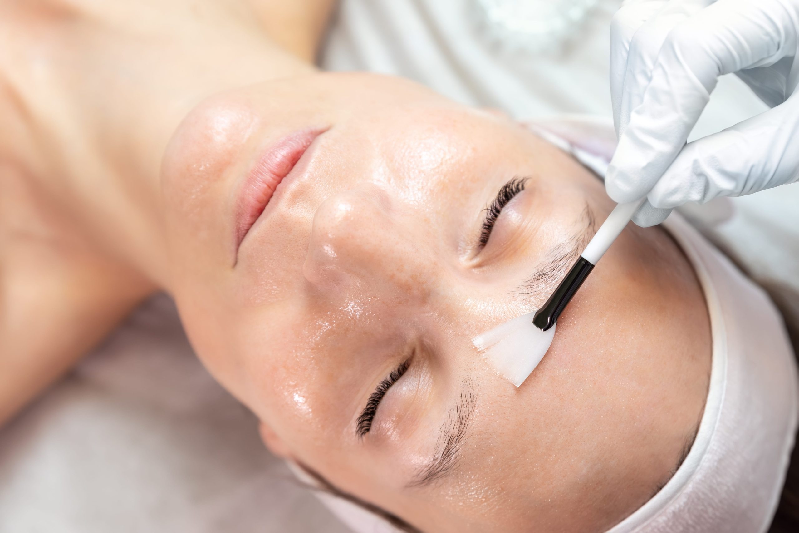 Medical chemical peel dermatology in Turlock, CA