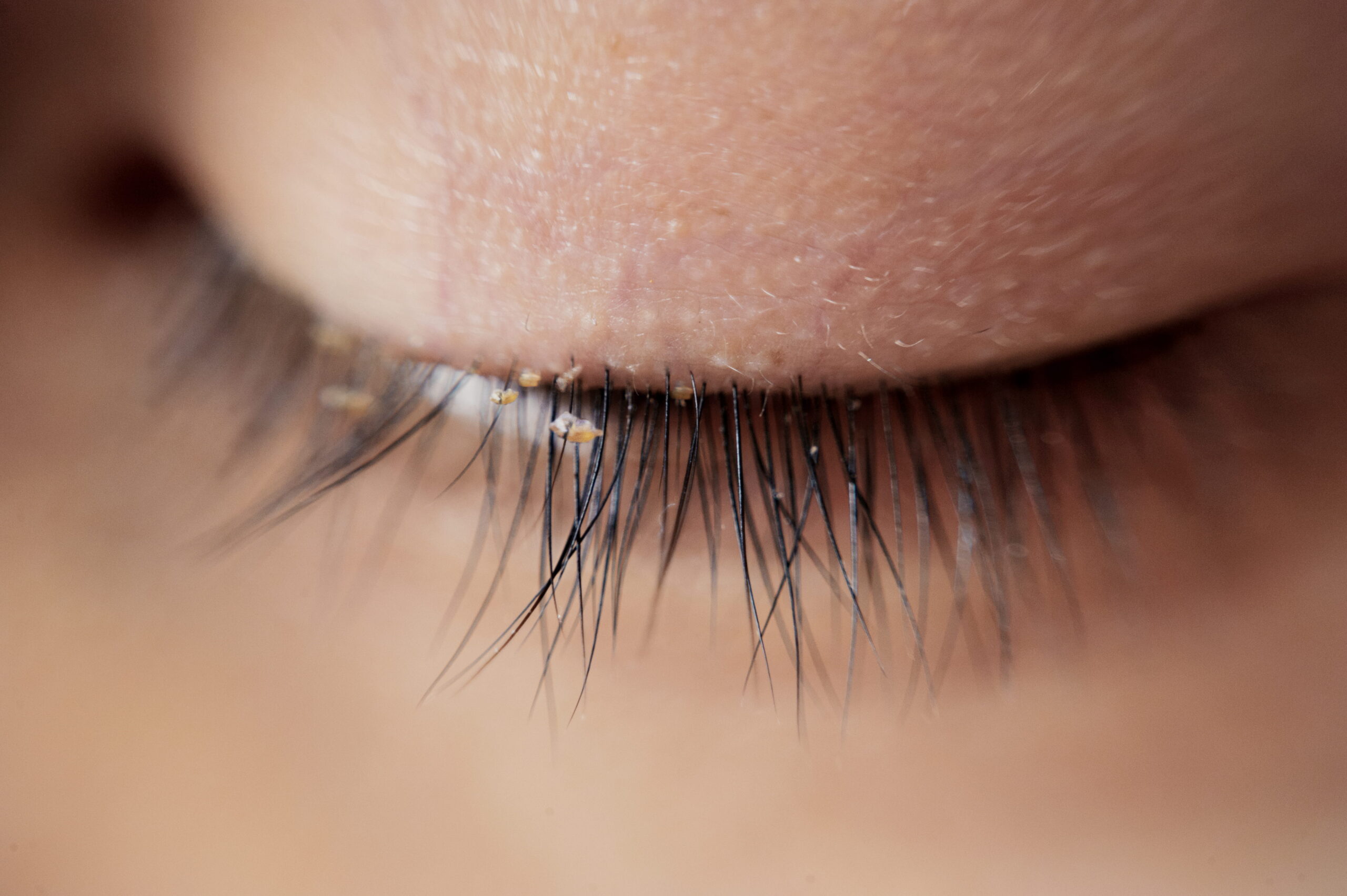 LATISSE® Eyelash treatment in Turlock, CA
